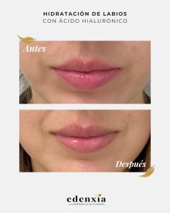 labios en un antes y un después