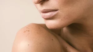 chica con manchas en el hombro